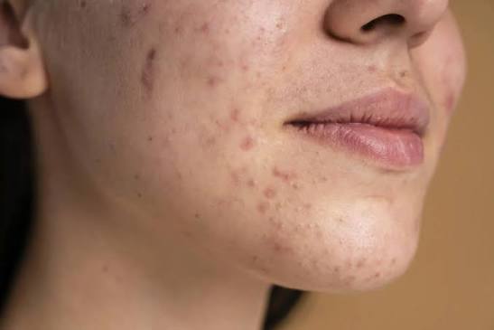 Acne Prone