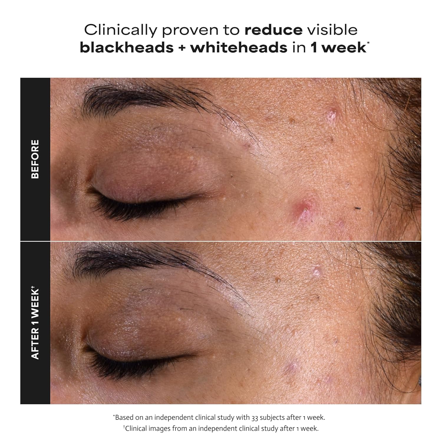 Paula’s Choice 2% BHA Liquid Exfoliant – Salicylic Acid Pore Treatment