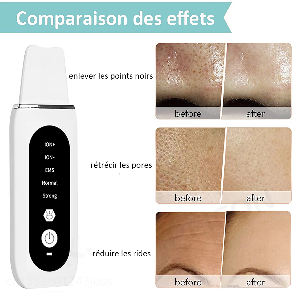 Stellar 5-in-1 Ultrasonic EMS Facial Device with Photon Therapy front view of the device